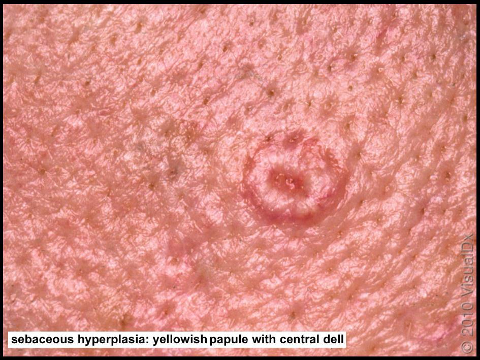 Sebaceous Hyperplasia Bengin localized enlargement (hypertrophy) of the sebaceous glands (oil glands) yellowish papules with central dell yellow color (oil gland) central dell (gland enlargement