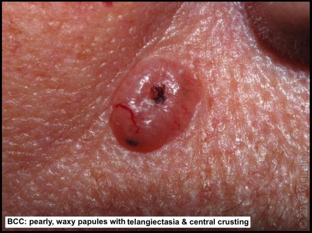 multiple similar lesions do not bleed or form hemorrhagic crust basal cell carcinoma