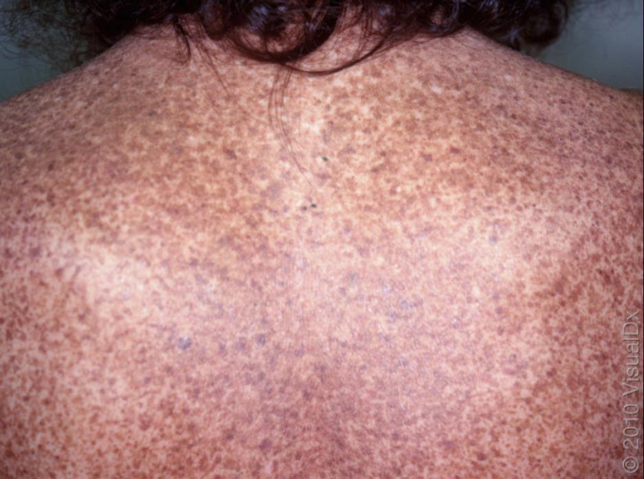 Solar lentigo (aka senile lentigo, age spot, or liver spot ) are benign pigmented macules appearing on fairskinned individuals chronically sun-exposed skin that is related to ultraviolet radiation No