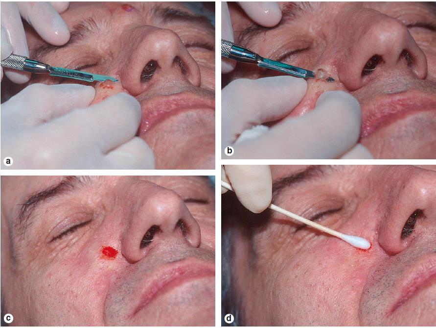 Shave Biopsy Technique 1. note location, triangulate, &/or digital photograph 2. prep skin with alcohol 3. anesthesia 1% lidocaine with epi (dermal injection & generally <1cc) 4.