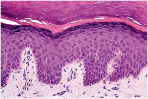 Basal Cell Carcinomas most common skin cancer arise from the basal