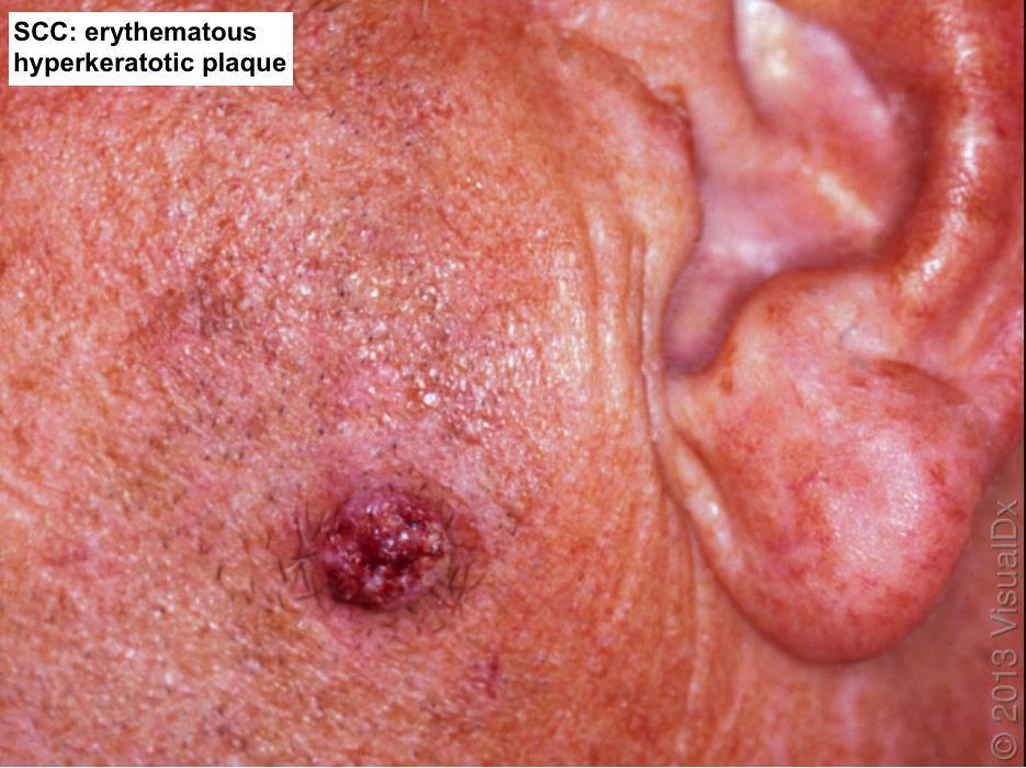 Squamous Cell Carcinoma:
