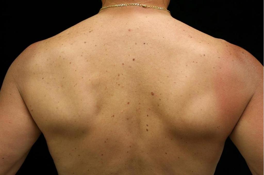 A 55-yo white male presents to your clinic and said he is there because his wife wanted you to check out his moles on his back.