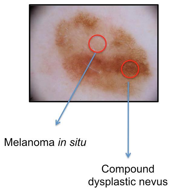 You find a lesion that you are concerned is a melanoma & plan to biopsy it melanocytic lesions that look