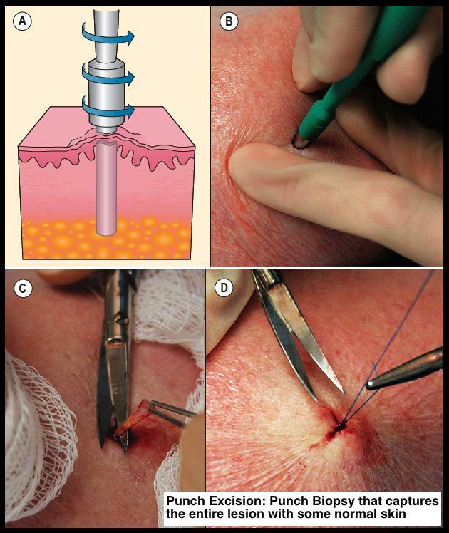excisional biopsy involves full thickness incision to the fat with the entire lesion captured