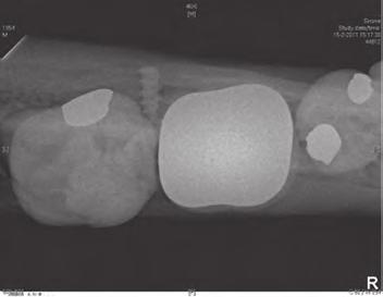 53%) screw was inserted in a root (fig. 2). During a follow up period of three years, this premolar remained asymptomatic and sensible to pulp-testing, and did not need endodontic treatment.