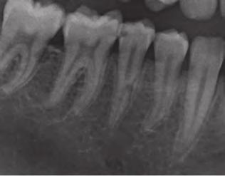 Chapter 5 Fig. 2) Radiographic view of element 45: a defect in the root is visible where the screw was inserted.