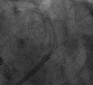 stent in longitudinal axis