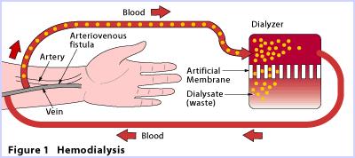 33 Dialysis treatments take between 2 and 5 hours, and may be repeated up to three times a week As well,