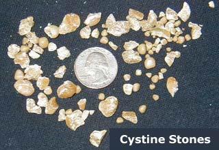 40 Kidney Stones Kidney stones are collections of