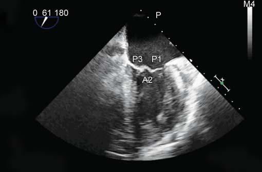 IJPUT end of the mitral commissure is viewed with the P3 segment on the left of the image and A3, A2, and A1 segments from the left to the right of the image (Fig. 4).