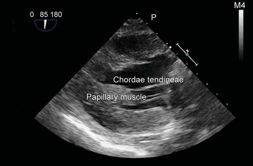 Once the presence of significant mitral regurgitation has been confirmed, the echocardiographer must investigate the precise location and mechanism of the lesion.