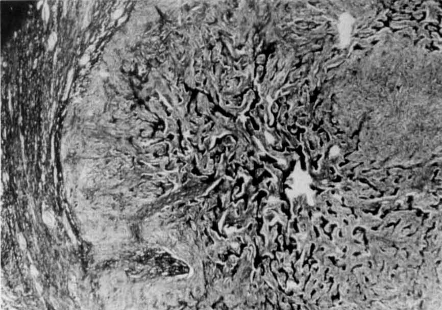 1360 CANCER June 1973 Vol. 31 FIG. 1. Low-power photomicrograph of a histologic cross-section of the tumor nodule, showing a central arrangement of mature partly mineralized bony trabeculae.