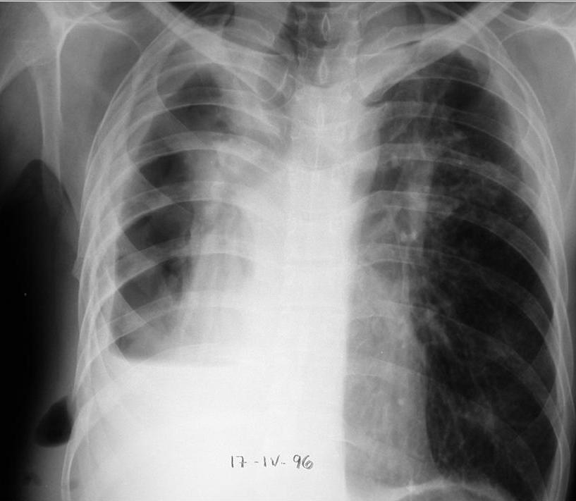 xxxxxx Miliary Tuberculosis Systemic hematogenous spread of TB 2% - 6% of TB patients More frequent with reactivation/pp TB Alone or with typical