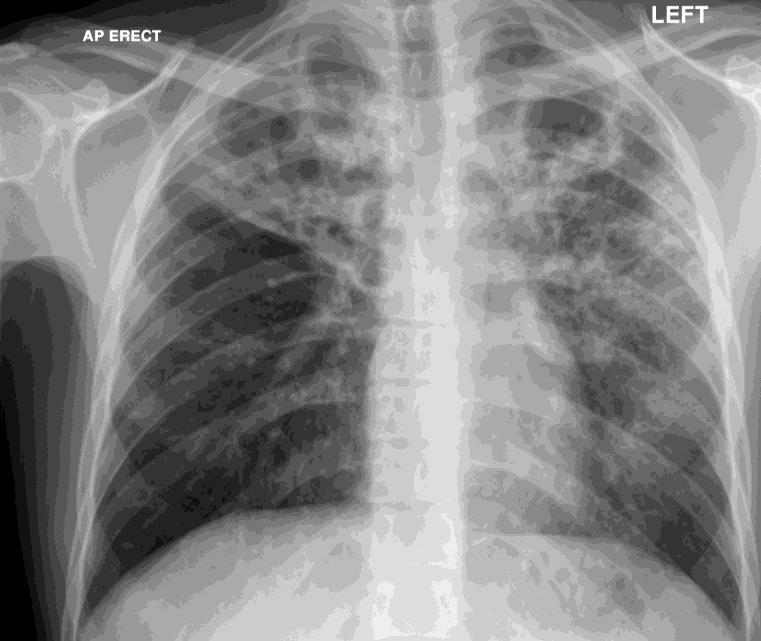 CXR: adenopathy, consolidation, effusions Exclude MDR-TB, treatment failure
