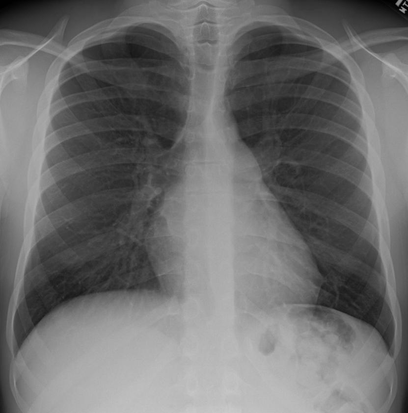 TB Infection: Typical Case