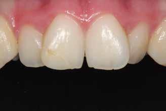 ACCREDITATION ESSENTIALS Figure 4: Preoperative retracted intraoral frontal view (1:1); open margin and lack of translucency are evident.
