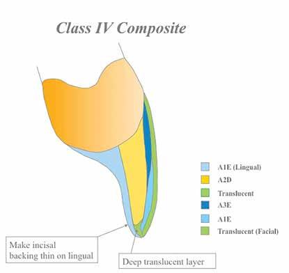 Harris Layering: IPS Empress Direct nanohybrid composite (Ivoclar Vivadent) was chosen for all layers of the restoration due to its strength, color, and polishability.