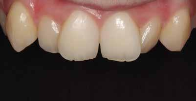 Discussion Shade matching is paramount in achieving an esthetic outcome in cases such as this.