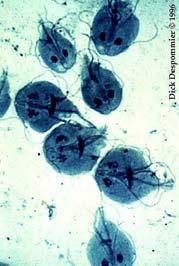 G. lamblia Pathology 3. Large numbers prevent fat absorbtion. a. Symptom is "fatty" stools. b.