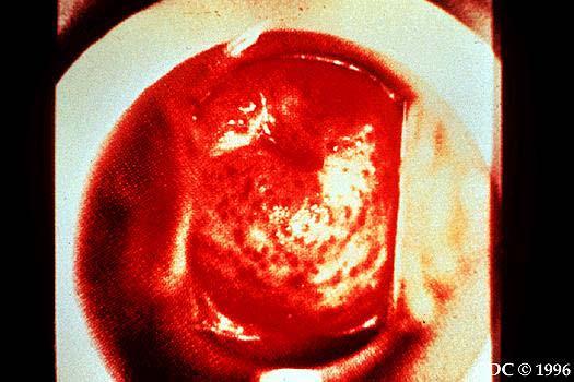 Strawberry cervix caused by T. vaginalis Trichomonas vaginalis d.