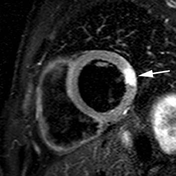 Cardiac MRI: LV EDV 219 ml - EF