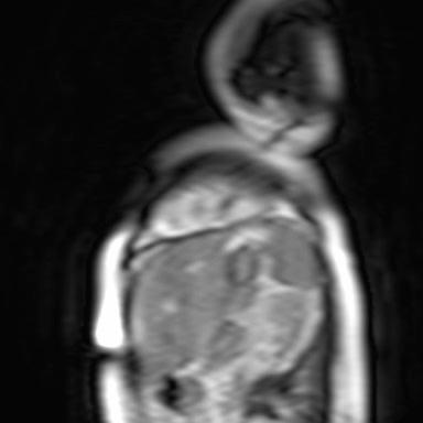 ventricles (LV EDV 324 ml - EF 9% / RV EDV 520 ml EF 7%)