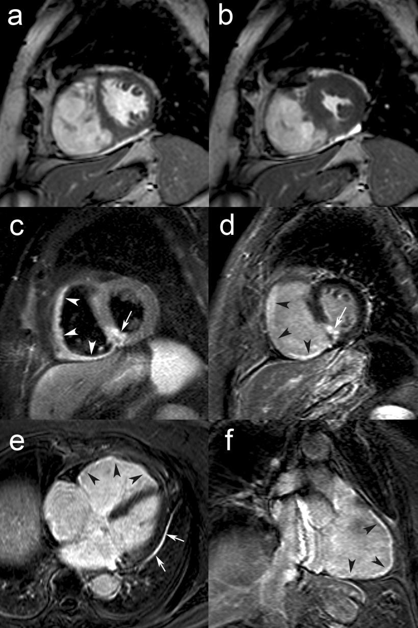 RV Myocardial Infarction (2) T2w-imaging shows focal edema of LV inferoseptal wall (arrow, c) and diffuse edema in RV wall (arrowheads, c).