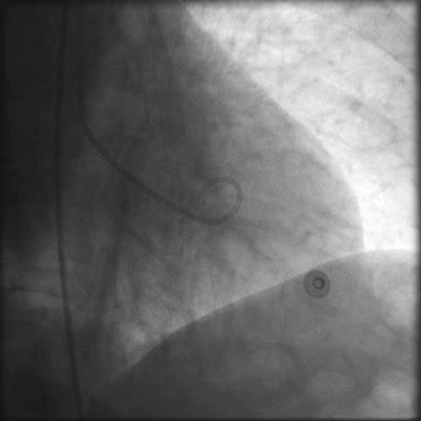 Stress Cardiomyopathy (Apical Form) 72-year-old woman admitted with chest pain