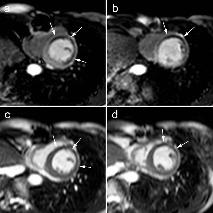 Recurrent Ischemia Post-Revascularization (2) Stress perfusion imaging at 2 short-axis levels (a,b) shows extensive anterior (including anteroseptum and lateral wall, arrows, a,b).