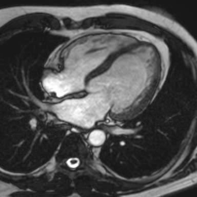 Comprehensive MRI in IHD (1) 46-year-old patient with