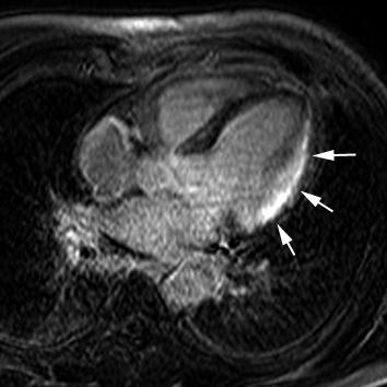 Comprehensive MRI in IHD (3) Rest MPI(previous slide) shows a perfusion defect in the LV anterolateral wall, corresponding to the area of