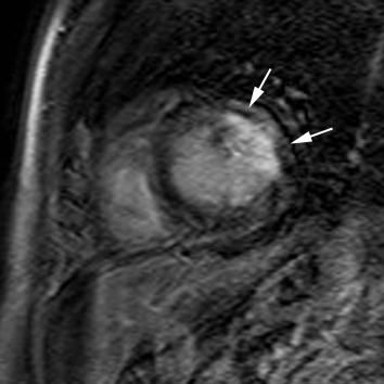 Late Gd imaging (suboptimal image quality) shows almost complete transmural enhancement of the LV anterolateral wall (segments 6,12,16).
