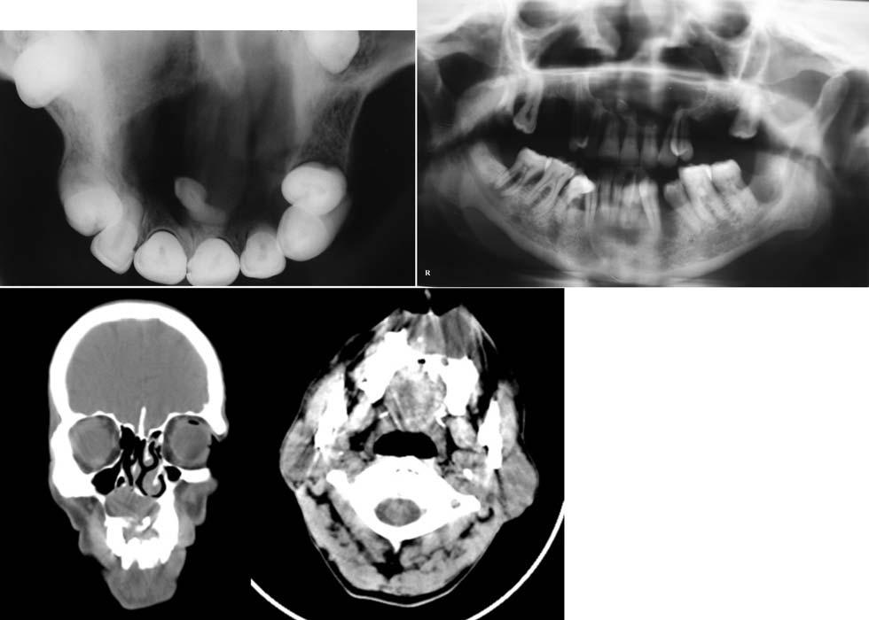 . The intraoral photograph shows a solitary well-defined swelling in the maxillary anterior labial vestibule extending from the left central incisor up to the left first premolar in Case 1.