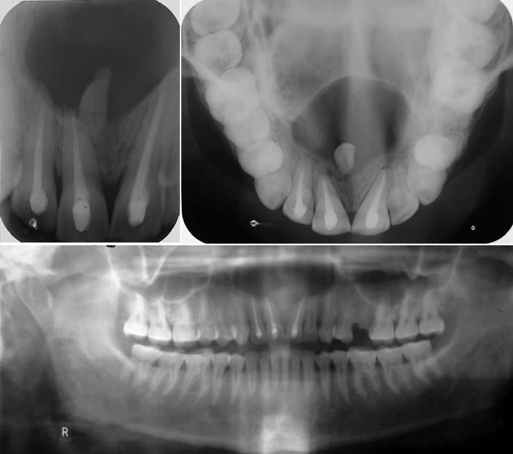 Dentigerous cyst associated with an impacted mesiodens: report of 2 cases C Fig. 6.. Intraoral periapical radiograph shows well-corticated periapical radiolucency with an impacted mesiodens.