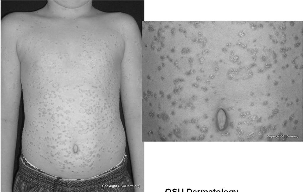 Guttate Psoriasis OSU Dermatology Guttate Psoriasis 2 nd most common form More common in children Can be related to strep