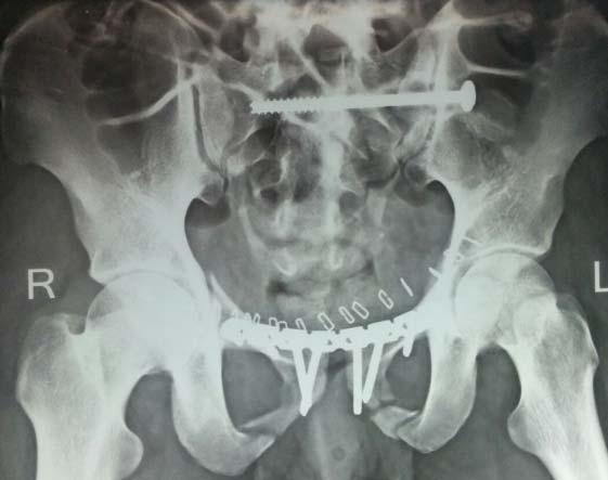 After plating for radius, pelvic injury was stabilised with anterior pubic plating and percutaneous iliosacral screw fixation (Fig.7).