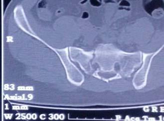 Fig 6: Preop x ray showing pubic diastases with left SI joint disruption. Fig 10: Post op Xray showing implant in situ.