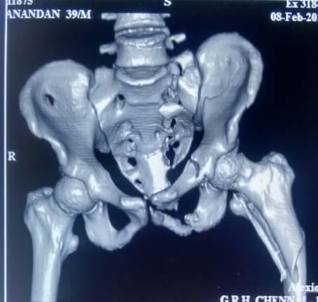 No Age & Sex 1 45/M 2 37/M 3 34/M 4 26/M 5 39/M 6 23/M Diagnosis Tile B injury ( left superior and inferior pubic rami fracture with left zone II sacral fracture) diastases > 2cm with SI joint