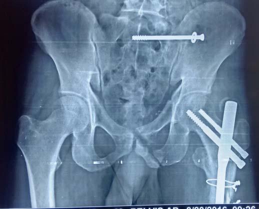 inferior pubic rami fracture, zone II Sacral fracture) Tile B injury ( left superior and inferior pubic rami fracture with left zone II sacral fracture) Tile B injury ( right side superior &