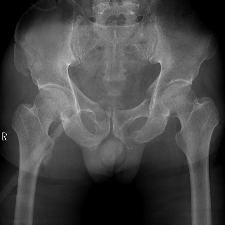 Won-Sik Choy, et al. inlet-outlet views of pelvis. Three dimensional pelvis CT scan was routinely performed to obtain more information about fracture pattern and operative plan.