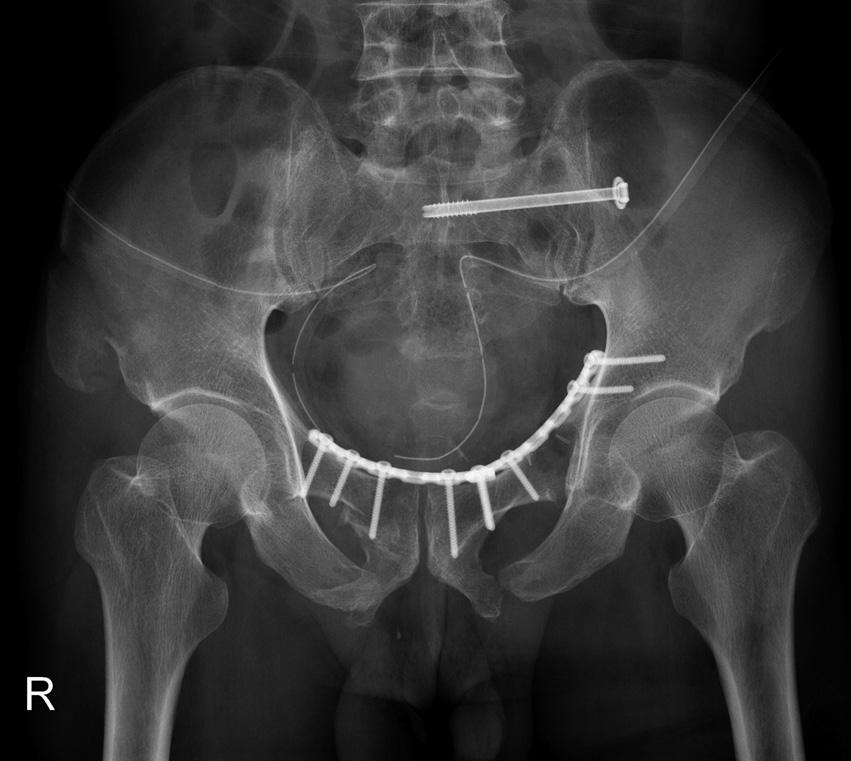 In the posterior lesions, there were 20 cases of sacral fractures (6 in type I and 14 in type II in the Denis 3 classification) and 12 of sacroiliac joint disruptions or dislocations.
