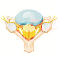 What is spinal canal stenosis?