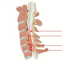 The spinal cord and spinal nerve spaces are narrowed by outgrowths of spondylophytes on the vertebral body and arch, displacement of parts of discs, and the thickening of the