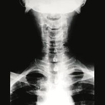 Spinal canal Thickening of the rear longitudinal ligament Herniated intervertebral disc Bony transformation of the vertebra How is spinal canal stenosis diagnosed?