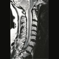 Cervical spine, side view Myelography, the introduction of a contrast agent into the dural sac, can provide additional information.