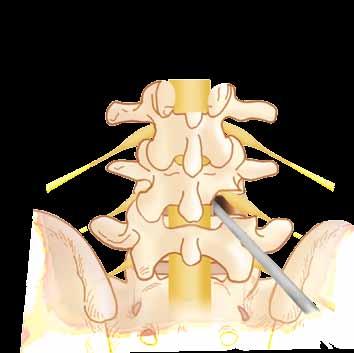 could open TLIF, a 3 to 6 inch incision is bone and disc are