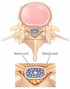 What is Lumbar Spinal Stenosis? Spinal stenosis is the narrowing of areas in the spine where nerve roots and the spinal cord must travel. It is most commonly caused by age-related spinal degeneration.
