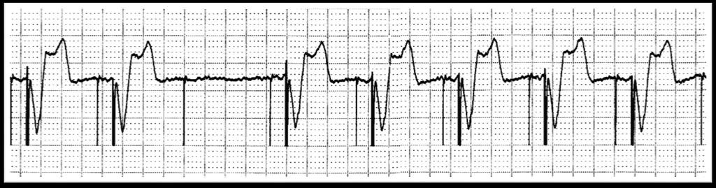 This is an example of over sensing in a DDD pacemaker. This is an example of cross-talk.