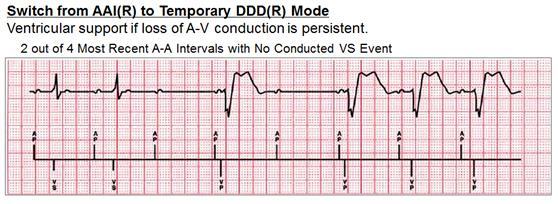 The pause in ventricular pacing is more than twice the programmed lower rate.